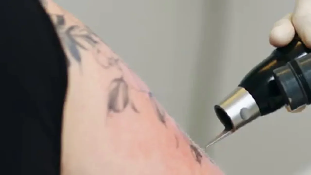 Probelaserung: das PicoSure-Handstück wird auf ein Tattoo am Oberarm gesetzt