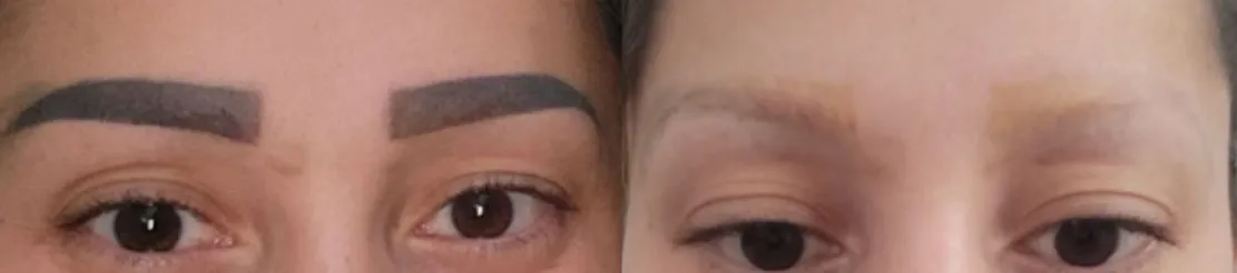 Vorher-Nachher: Microblading der Augenbrauen nach 4 Behandlungen entfernt