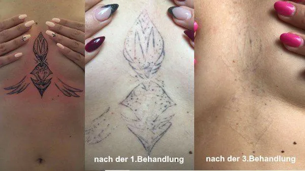 Vorher-Nachher: Ornament am Brustbein: vorher, nach der 1. und nach der 3. Behandlung